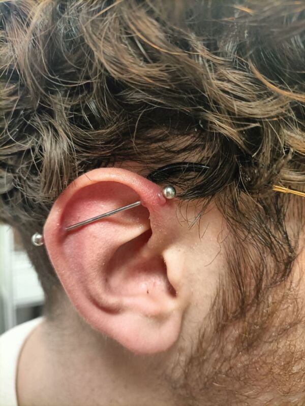 Soins chéloïdes piercing