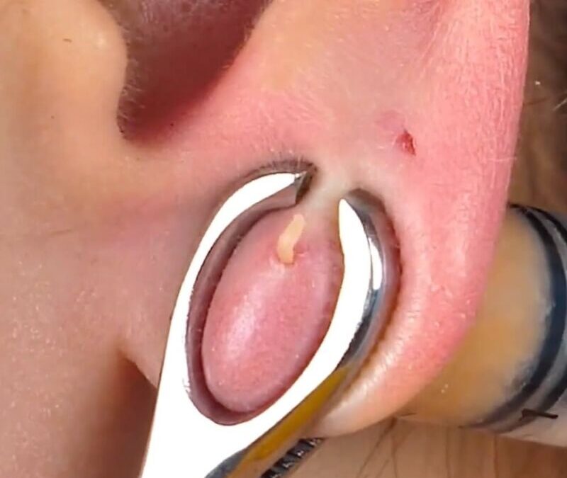 Soin piercing: choisir le meilleur désinfectant pour éviter les infections